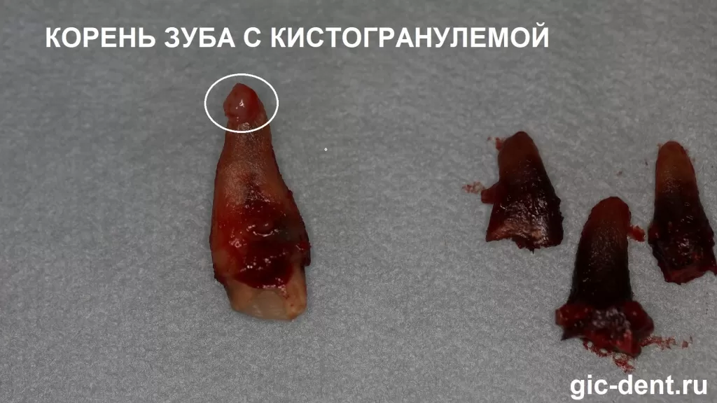 Так выглядит кистогранулема на корне атравматично удаленного зуба. Хирург-имплантолог Дахкильгов Магомед, Немецкий имплантологический центр Уматгиреевич